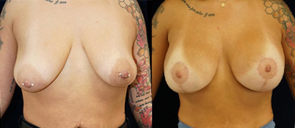 Breast Augmentation Before & After Gallery - Patient 141067929 - Image 1