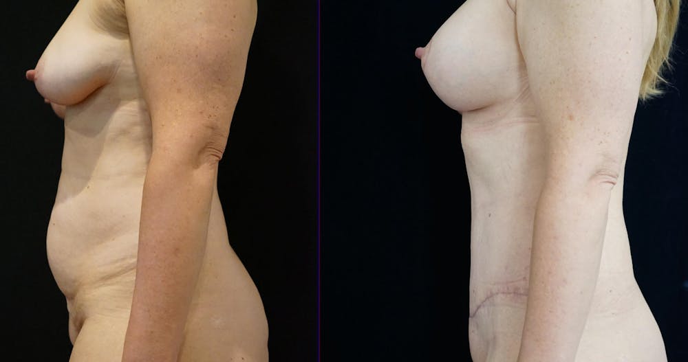 Abdominoplasty Before & After Gallery - Patient 385014 - Image 3