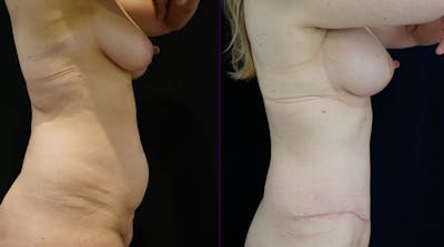 Abdominoplasty Before & After Gallery - Patient 385014 - Image 2