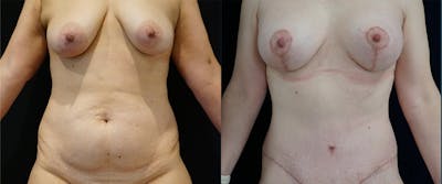 Abdominoplasty Before & After Gallery - Patient 385014 - Image 4