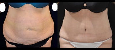 Abdominoplasty Before & After Gallery - Patient 710550 - Image 1