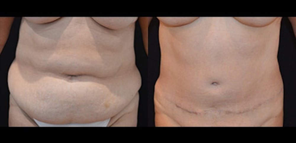Abdominoplasty Before & After Gallery - Patient 372950 - Image 1