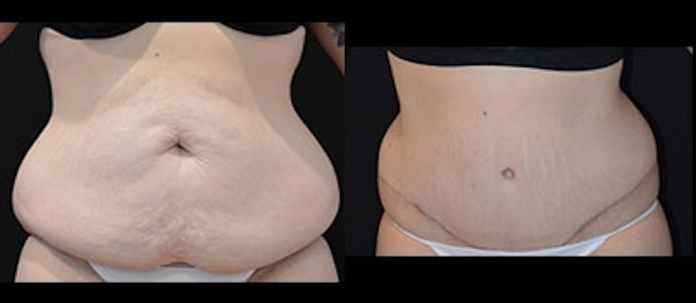 Abdominoplasty Before & After Gallery - Patient 172002 - Image 1