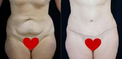 Abdominoplasty Before & After Gallery - Patient 381007 - Image 1
