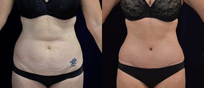 Abdominoplasty Before & After Gallery - Patient 439447 - Image 1