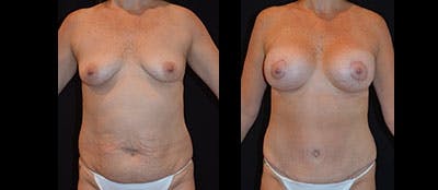 Abdominoplasty Before & After Gallery - Patient 173534 - Image 1
