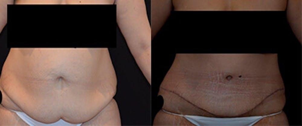 Abdominoplasty Before & After Gallery - Patient 954902 - Image 1