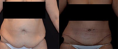 Abdominoplasty Before & After Gallery - Patient 954902 - Image 1