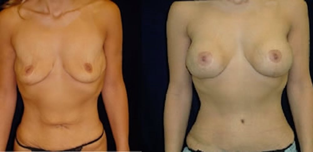 Abdominoplasty Before & After Gallery - Patient 137450 - Image 1