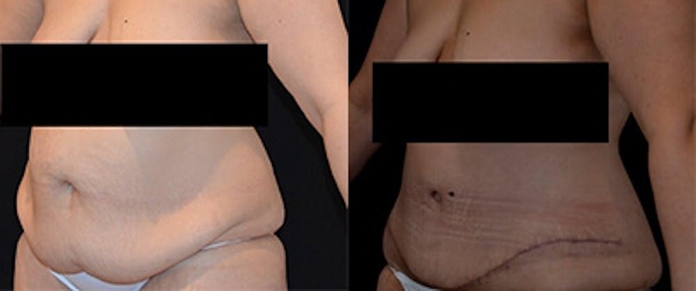 Abdominoplasty Before & After Gallery - Patient 114292 - Image 1