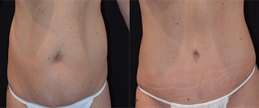 Abdominoplasty Before & After Gallery - Patient 252757 - Image 1