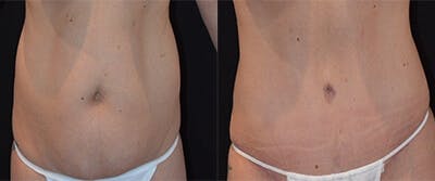 Abdominoplasty Before & After Gallery - Patient 252757 - Image 1