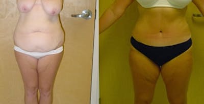 Abdominoplasty Before & After Gallery - Patient 641743 - Image 1