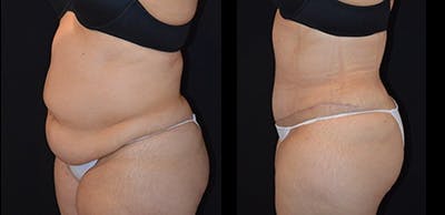 Abdominoplasty Before & After Gallery - Patient 721051 - Image 1
