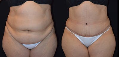 Abdominoplasty Before & After Gallery - Patient 191190 - Image 1