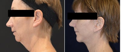 Mini-Facelift Before & After Gallery - Patient 139151 - Image 1