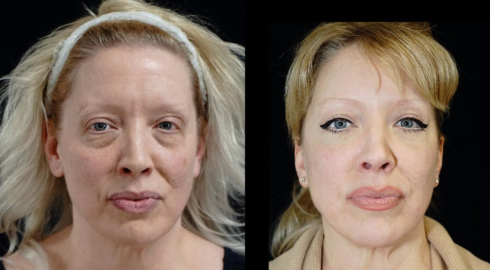 Blepharoplasty Before & After Gallery - Patient 309333 - Image 1