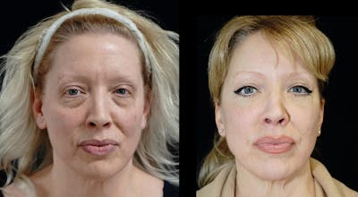 Blepharoplasty Before & After Gallery - Patient 309333 - Image 1