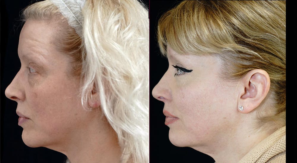 Blepharoplasty Before & After Gallery - Patient 309333 - Image 5