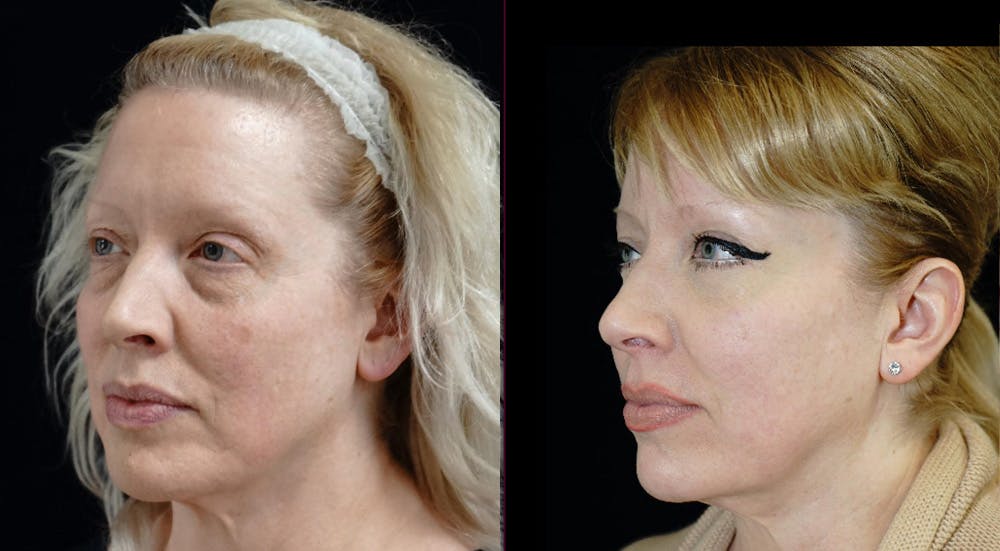 Blepharoplasty Before & After Gallery - Patient 309333 - Image 4