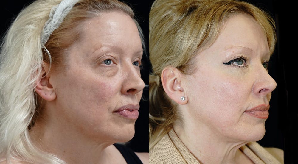 Blepharoplasty Before & After Gallery - Patient 309333 - Image 2