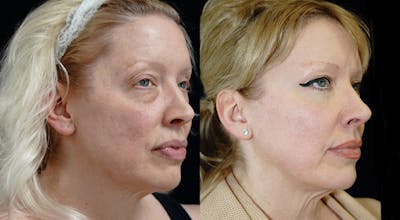Blepharoplasty Before & After Gallery - Patient 309333 - Image 2