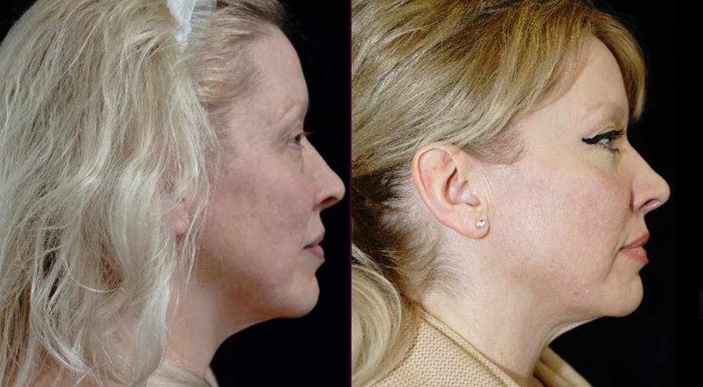 Blepharoplasty Before & After Gallery - Patient 309333 - Image 3