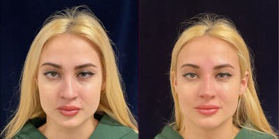 Liquid Rhinoplasty Before & After Gallery - Patient 228328 - Image 1