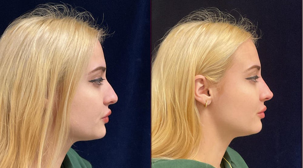 Liquid Rhinoplasty Before & After Gallery - Patient 228328 - Image 2