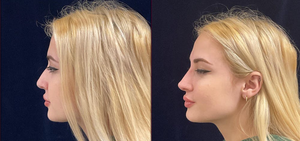 Liquid Rhinoplasty Before & After Gallery - Patient 228328 - Image 3