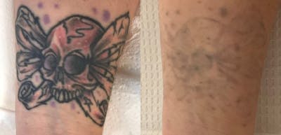 Laser Tattoo Removal Before & After Gallery - Patient 234382 - Image 1