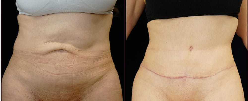 Abdominoplasty Before & After Gallery - Patient 272103 - Image 1