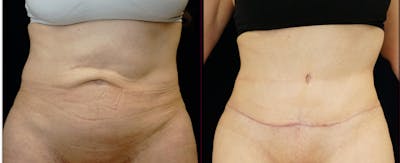 Abdominoplasty Before & After Gallery - Patient 272103 - Image 1