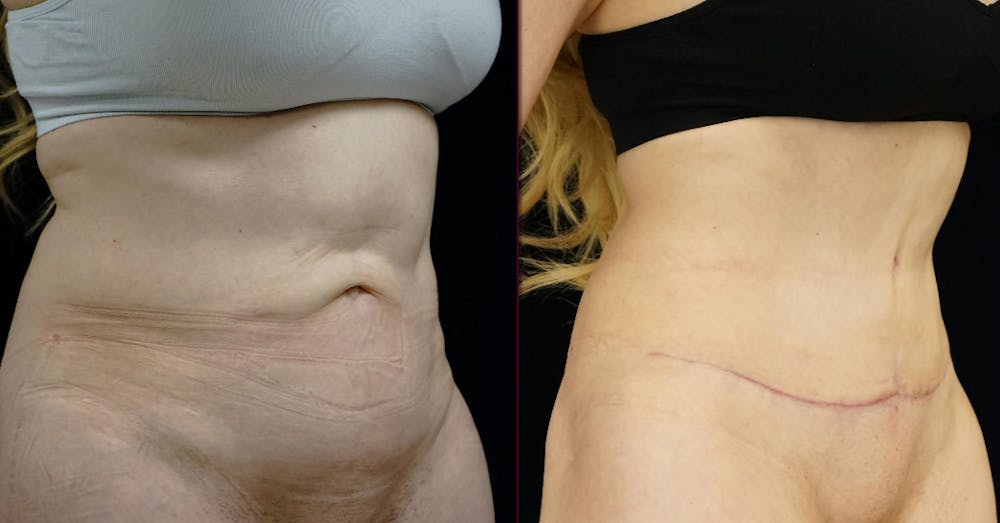 Abdominoplasty Before & After Gallery - Patient 272103 - Image 2