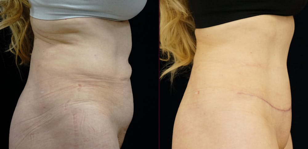 Abdominoplasty Before & After Gallery - Patient 272103 - Image 3