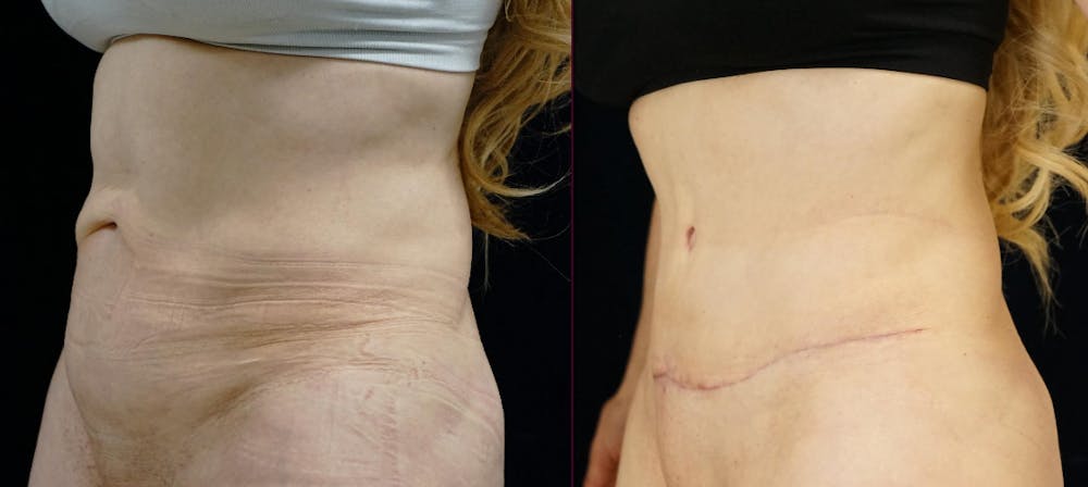 Abdominoplasty Before & After Gallery - Patient 272103 - Image 4