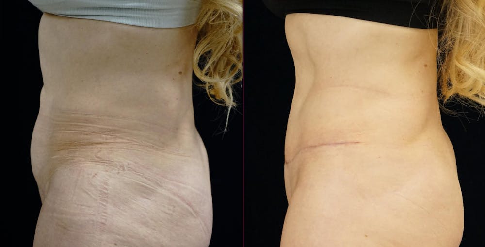 Abdominoplasty Before & After Gallery - Patient 272103 - Image 5