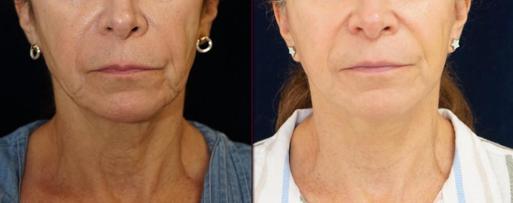 Mini-Facelift Before & After Gallery - Patient 163635 - Image 1