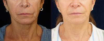 Mini-Facelift Before & After Gallery - Patient 163635 - Image 1