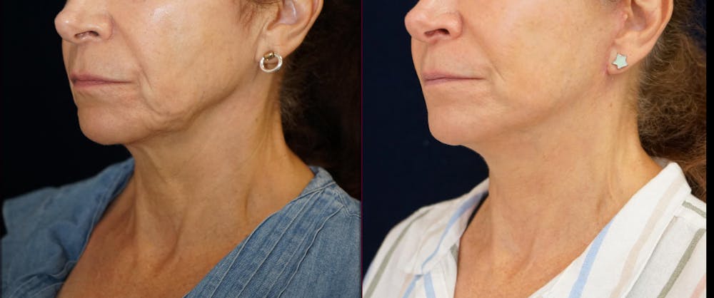 Mini-Facelift Before & After Gallery - Patient 163635 - Image 4