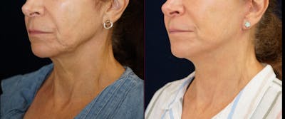 Mini-Facelift Before & After Gallery - Patient 163635 - Image 4