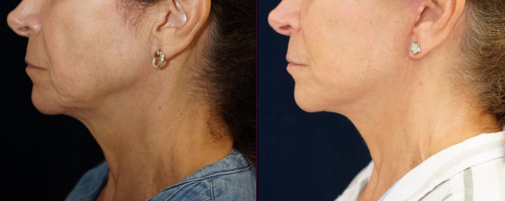 Mini-Facelift Before & After Gallery - Patient 163635 - Image 5