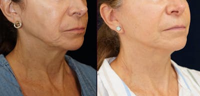Mini-Facelift Before & After Gallery - Patient 163635 - Image 2
