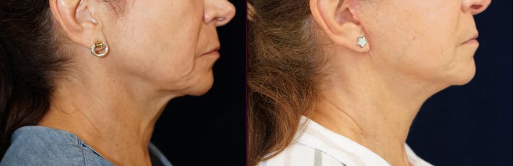 Mini-Facelift Before & After Gallery - Patient 163635 - Image 3