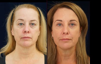 Blepharoplasty Before & After Gallery - Patient 404097 - Image 1