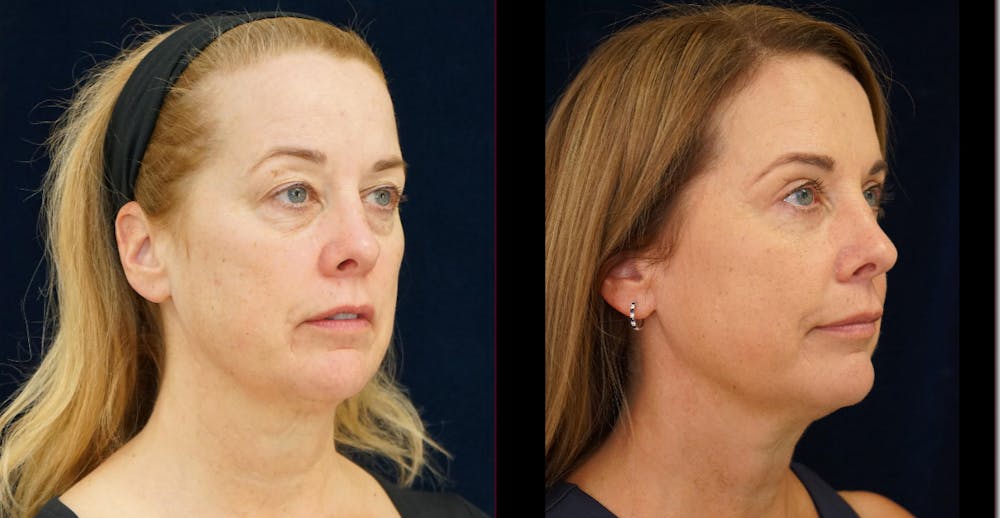 Blepharoplasty Before & After Gallery - Patient 404097 - Image 2