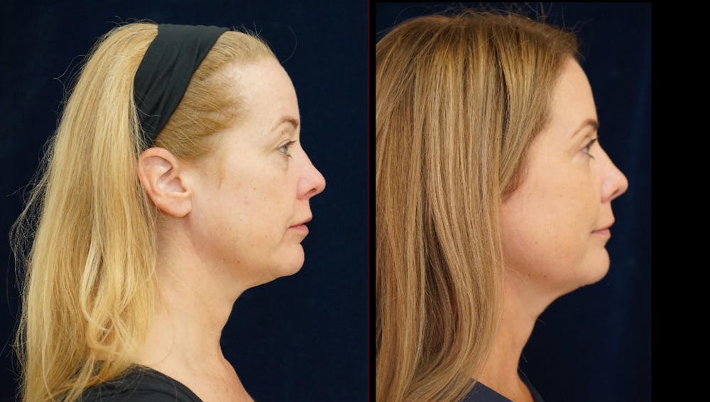 Blepharoplasty Before & After Gallery - Patient 404097 - Image 3