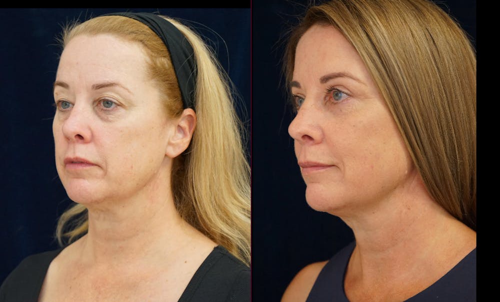 Blepharoplasty Before & After Gallery - Patient 404097 - Image 5