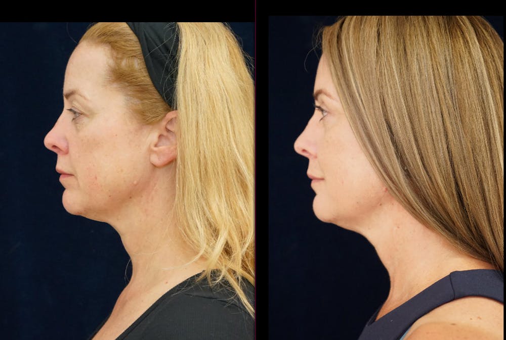 Blepharoplasty Before & After Gallery - Patient 404097 - Image 6