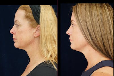 Blepharoplasty Before & After Gallery - Patient 404097 - Image 6